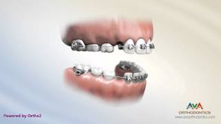 preview picture of video '2x4 Braces - Orthodontic Treatment'