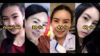 เสริมหน้าผากด้วยแผ่นซิลิโคน เสริมหน้าผากด้วยแผ่นซิลิโคน