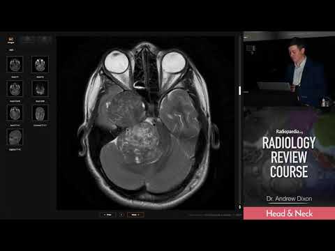 Trigeminal Schwannoma - Radiology Review Course