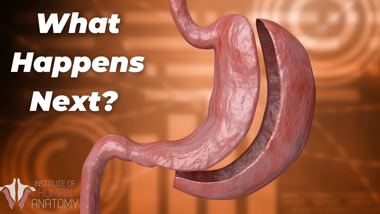 Removing 80% of the Stomach