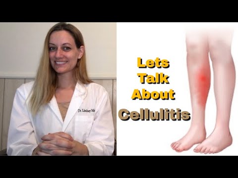 CELLULITIS: Everything You Need To Know! Symptoms. Cause. Risk Factors. Treatment. Prevention.