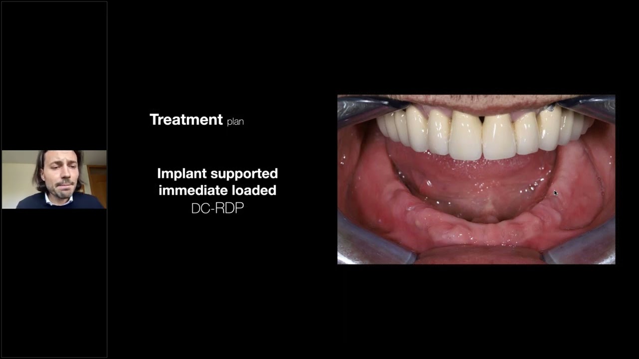 BEGO Implant Systems – Double crown retained removable dental prosthesis alternative to All on X concepts