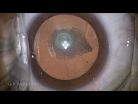 Posterior Polar Cataract Surgery 