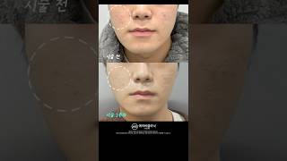 여드름 흉터 이거 하나만 기억하세요❗