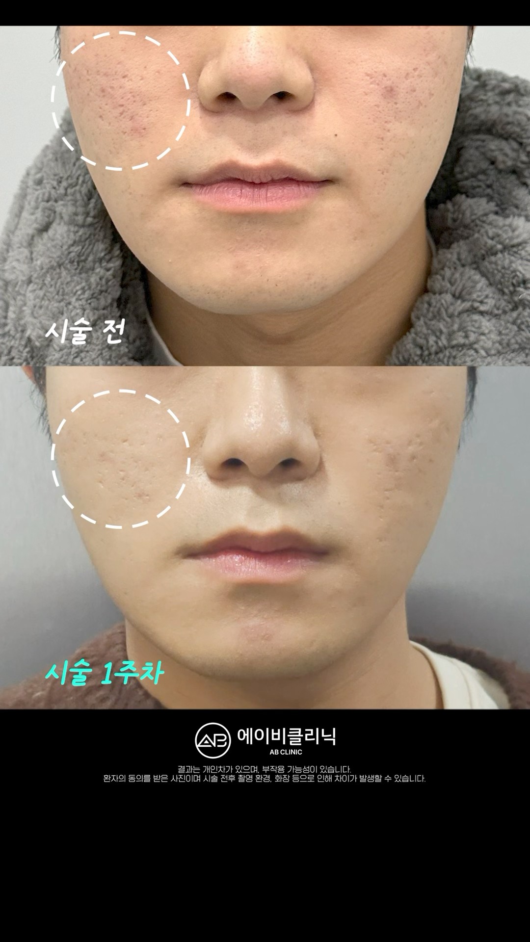 여드름 흉터 이거 하나만 기억하세요❗