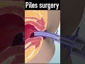 3d Animation Of Piles Rubber Band Surgery Shorts