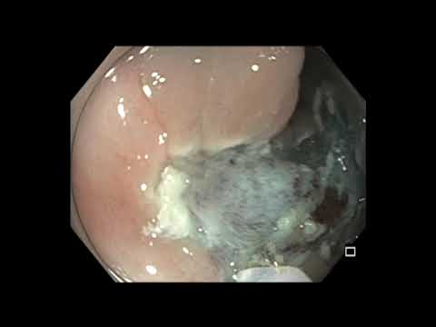 Colonoscopia: resección endoscópica de la mucosa del tumor lateral no granular (LST-NG) en colon descendente