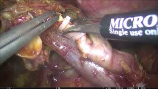 Asvide: Laparoscopic right extended hepatectomy for perihilar cholangiocarcinoma: surgical...