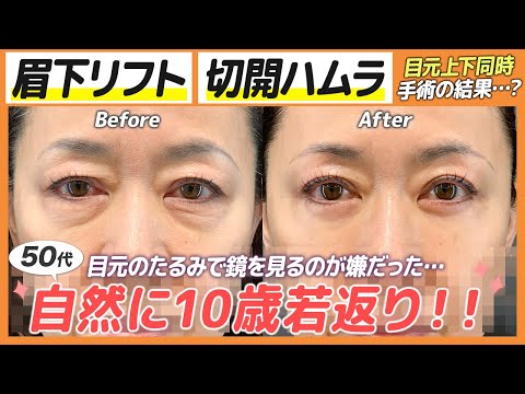 50代！目元のたるみを取って、大きな変化！【眉下切開＋切開ハムラ】