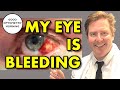 HOW TO TREAT BROKEN BLOOD VESSEL IN EYE: what does it mean & how to treat bleeding or bloodshot eye - Good Optometry Morning: Youtube Eye Doctor HOW TO TREAT BROKEN BLOOD VESSEL IN EYE: what does it mean & how to treat bleeding or bloodshot eye
