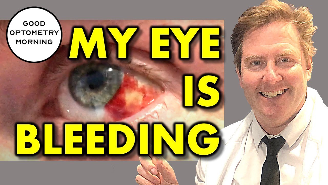 HOW TO TREAT BROKEN BLOOD VESSEL IN EYE: what does it mean & how to treat bleeding or bloodshot eye