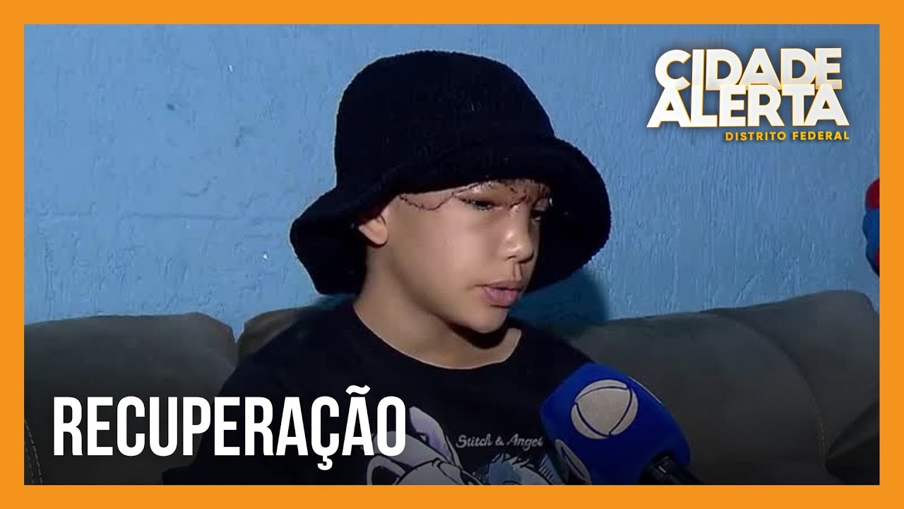 Menina que teve couro cabeludo arrancado se recupera em casa | Cidade Alerta DF
