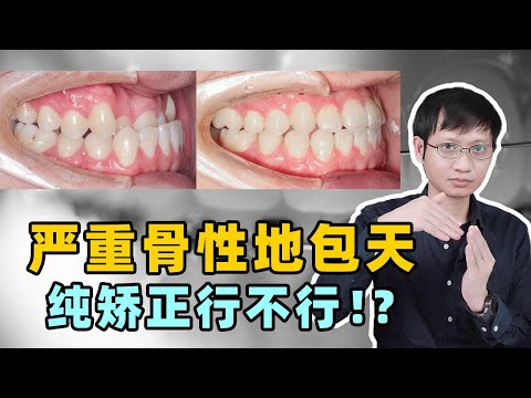 牙齒地包天