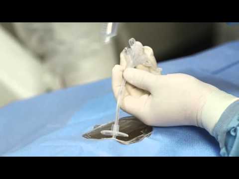 Radiographically Place Gastrostomy Feeding Tubes