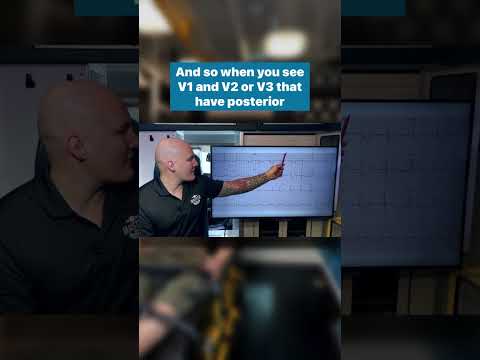 V1, V2 Depression, Think Posterior MI