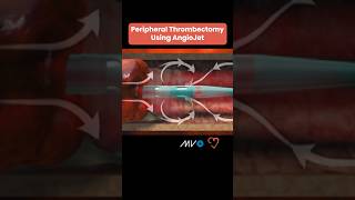 AngioJet Peripheral Thrombectomy System u2728ud83eude78 #cardiologyeducation #cardiology
