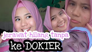 Acne story | jerawat hilang tanpa ke dokter | cerita melawan jerawat | Rohmayanti