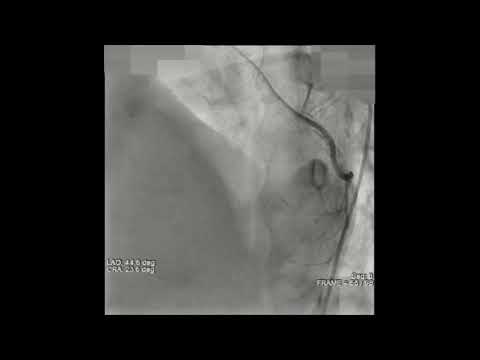 Total Arterial Revascularisation