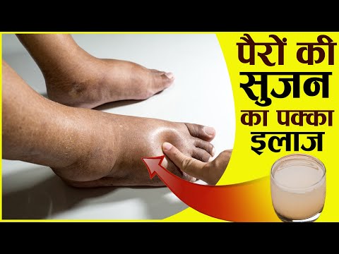 पैरों की सूजन का रामबाण घरेलु उपचार | Ankle & Feet Swelling Treatment at Home | Soojan | सूजन