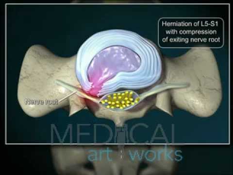Artroza ligamentelor tratamentului articulației genunchiului