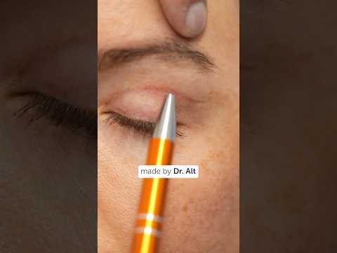 #oberlidstraffung #oderlid #lidstraffung #düsseldorf #plastischechirurgie #blepharoplastysurgery