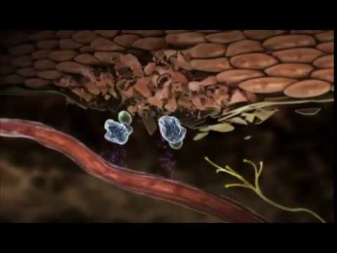 Mydocalmum se usato in osteocondrosi Diffusa osteocondrosi della lombari
