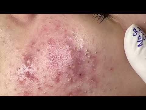 NASA SPA BEST ACNE BLACKHEADS TREATMENT #5889866689815