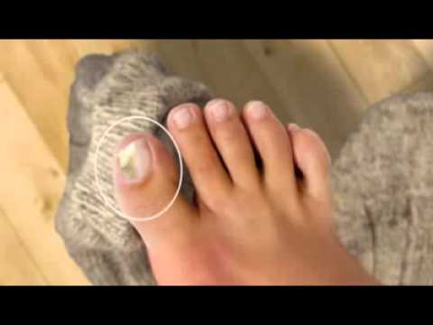 nail deformációja láb gombás távolítsa el a lábkörmét, ha gombás