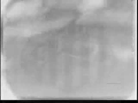 SANTOS 5 X 1 BAHIA FINAL CAMPEONATO BRASILEIRO DE 1961.wmv