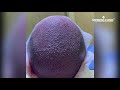 Fue Hair Transplant All Process*