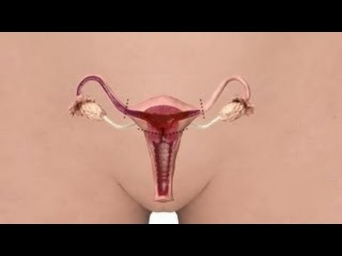 Laparoscopy Hospital - Frequently asked questions about hysterectomy