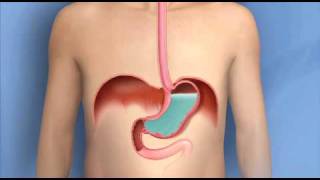 Heartburn, Acid Reflux, GERD-Mayo Clinic