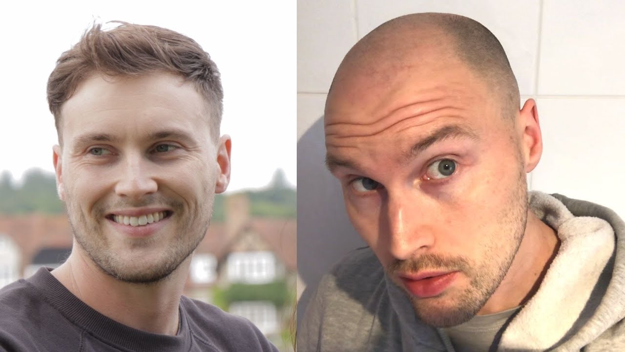 Why Did I Go BALD So FAST?