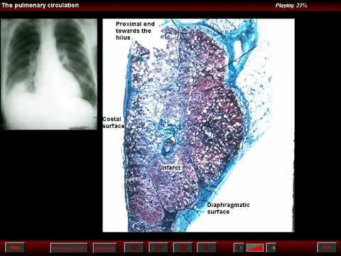 diagnosis of PE - Radiographic findings - acute pe   hamptons hump