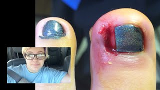 INGROWN TOENAIL REMOVAL RECOVERY VLOG WITH PICTURES