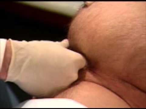 physical examination 8-Male Genitalia, Rectum and Hernias -  Supine Examination of the Rectum 