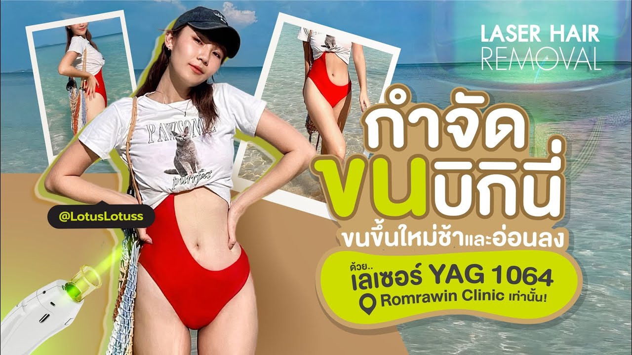 แก้ปัญหาขนคุดจากการโกนแว็กซ์ ด้วยเลเซอร์ YAG 1064