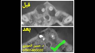 علاج أكياس جراحة فوق الاسنان نهائيا باستخدام حشوات الجذور وبدون عملية جراحية.