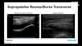 Ultrasound Evaluation of the Anterior Knee 