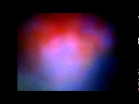 Come togliere lentiggini video Gel di skinoren o crema da pigmentazione