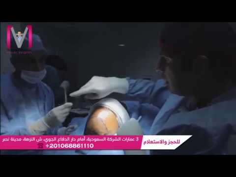 زراعة الشعر الطبيعي بالاقتطاف