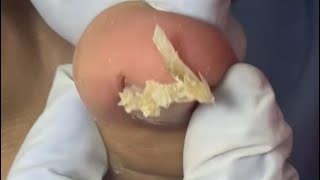 Ep_8920 Foot nails skin removal 👣 สงสารหนูจัง..เจ็บมาก 😅 (clip from Thailand)