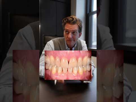 She had BRACES for YEARS and was left with this - SMILE MAKEOVER