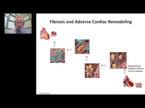 Peter McCullough - Galectin 3 A Step Towards a Clearer Pathway in Heart Failure Management - YouTube