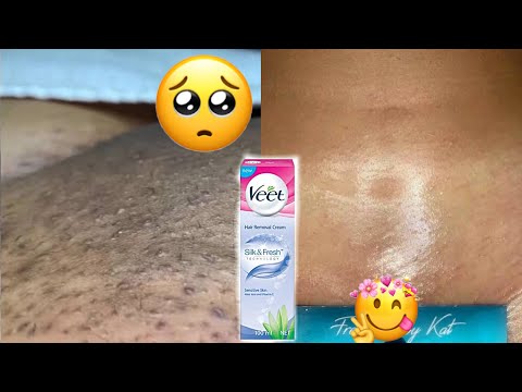 I USED VEET HAIR REMOVAL CREAM TO GET RID OF INGROWN...