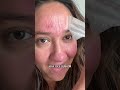 Does Hero’s Mighty Patch™ Forehead patch REALLY WORK??