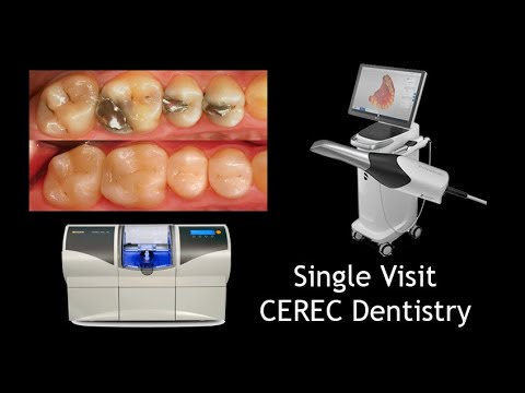 Single Visit CAD/CAM CEREC Dentistry Step by Step
