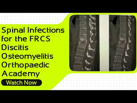 Spinal Infections