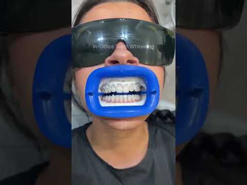 Watch the process of our in-office teeth whitening treatment ✨🤍