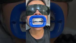 Watch the process of our in-office teeth whitening treatment ✨🤍